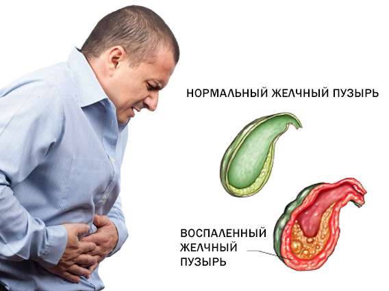 ХОЛЕЦИСТОПАТИЯ