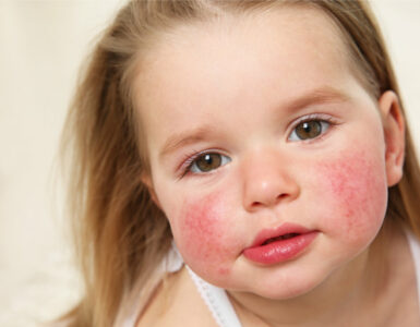 Профилактика аллергии у детей